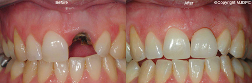 Dental Implants Dental Implants
