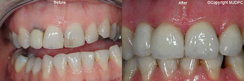 Dental Implants Dental Implants