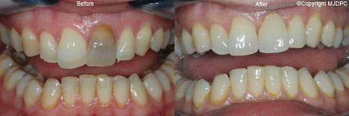 Dental Implants Dental Implants