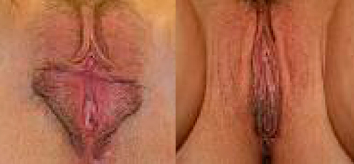Labiaplast Before and After Photos Labiaplast Before and After Photos