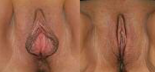 Labiaplasty Before and After Photos Labiaplasty Before and After Photos