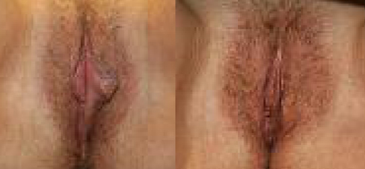 Labiaplasty Before and After Photos Labiaplasty Before and After Photos
