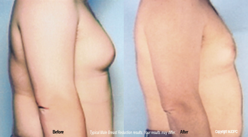 Breast Reduction  Pinehurst Surgical Clinic