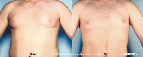 Breast Reduction  Pinehurst Surgical Clinic