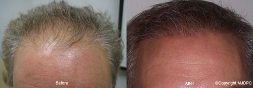 NeoGraft NeoGraft
