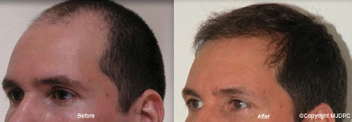 NeoGraft NeoGraft
