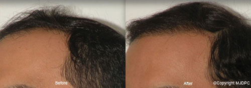 NeoGraft NeoGraft