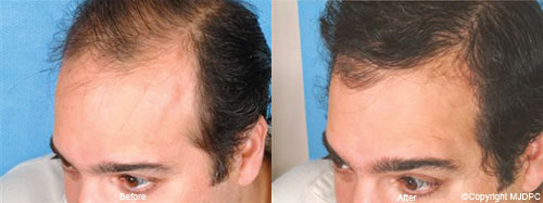 NeoGraft NeoGraft