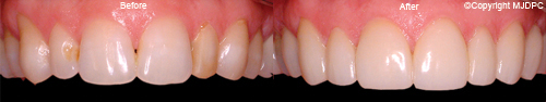 Veneers Veneers