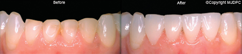 Veneers Veneers
