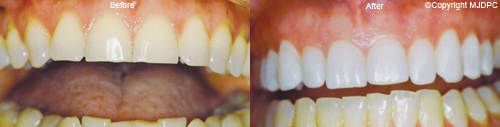 Tooth Whitening Tooth Whitening